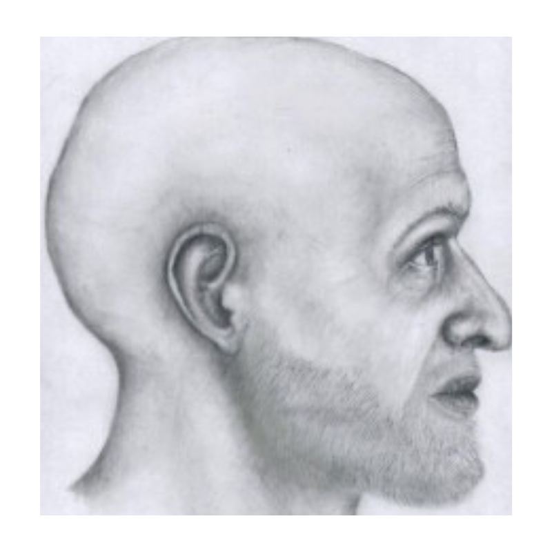 guy whose jaw fell off from radium guy whose jaw fell off from radium